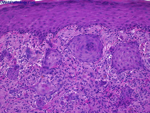 Scrotum_Granular Cell Tumor3(1).jpg